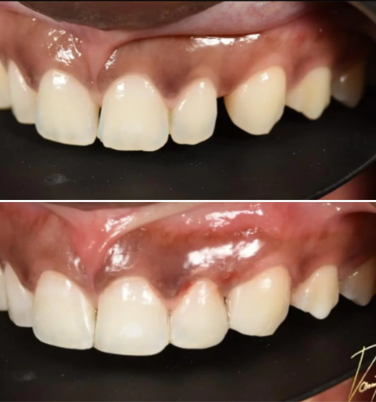 Before and after comparison of dental veneers showing improved tooth shape and alignment